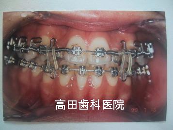 開咬